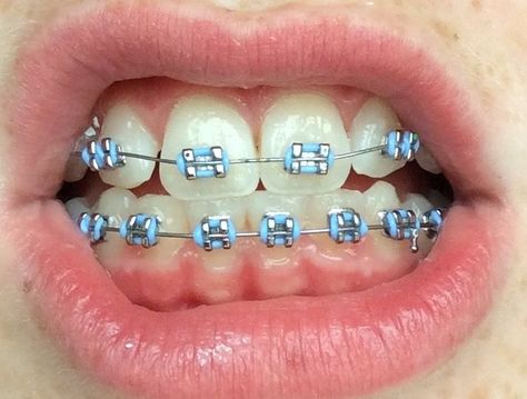 Light Blue Braces, Rainbow Braces, Braces Transformation, Dental Braces Colors, Braces Colors Combinations, Pink Braces, Braces Colors Ideas, Braces Food, Braces Bands