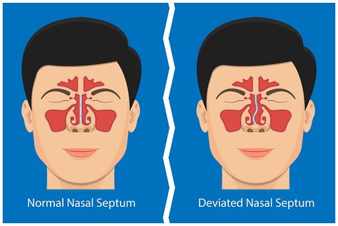 Do you have difficulty in breathing? Are you suffering from deviated septum? A Nose Septum Surgery can help you to find relief. Deviated Nasal Septum Surgery, Deviated Nasal Septum, Nasal Septum, Nose Septum, Nasal Cavity, Perfect Nose, Lungs Health, Nasal Passages, Emergency Plan