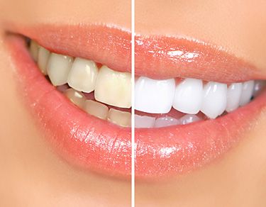 Natural Teeth Whitening Remedies, Kedokteran Gigi, Tooth Whitening, Teeth Whitening Remedies, Beautiful Teeth, Teeth Whitening Diy, Laser Teeth Whitening, Teeth Whitening System, Best Teeth Whitening