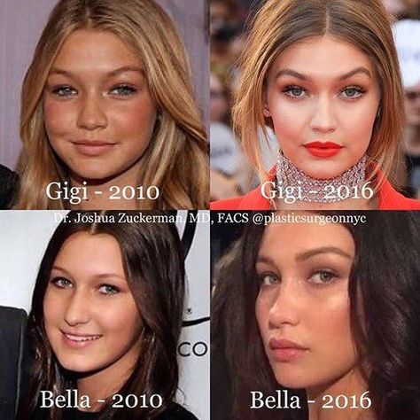 Both Gigi and Bella Hadid before and after plastic surgery Gigi And Bella Hadid, Gigi And Bella, Famous Sisters, Plastic Surgery Photos, 90s Grunge Hair, Celebrity Plastic Surgery, Tori Amos, Celebrities Before And After, Nose Job