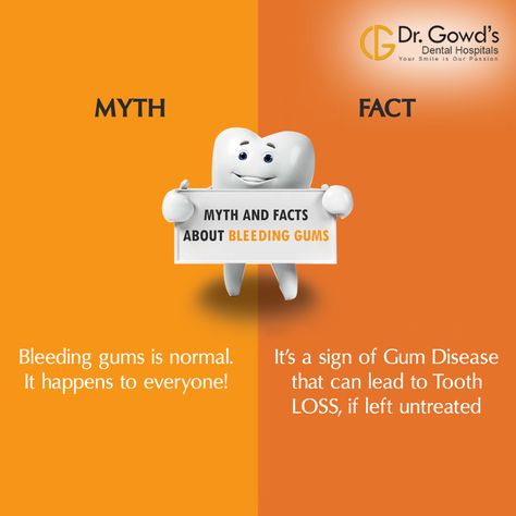 Myth & Fact – Bleeding Gums    MYTH - Bleeding gums is normal. It happens to everyone! FACT - Bleeding gums is a sign of gum disease, which means there's nothing normal about it. It only means that you haven't visited your dentist for quite sometime now and that a lot calculus (hard deposits stuck on your teeth) have already accumulated, making your gums swell and bleed. Gum disease if left untreated may cause the loss of your teeth. Dentist Story Ideas, Dental Myths And Facts, Dental Facts Did You Know, Dental Campaign, Dental Content, Dental Poster, Dentist Ideas, Myth Fact, Dental Smile