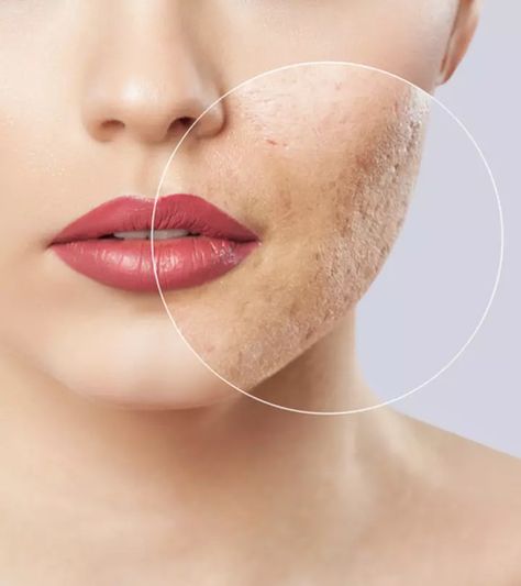 Types Of Acne Scars And How To Treat Them Naturally At Home Best Acne Scar Removal, Hypertrophic Scars, Antiaging Skincare Routine, Types Of Acne, Acne Scar Removal, Skin Resurfacing, Laser Skin, Face Acne, Scar Removal