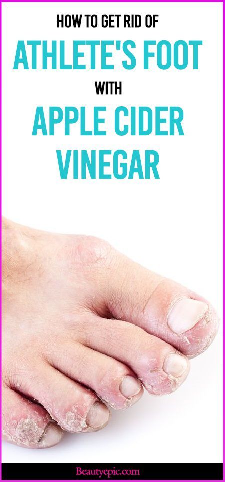 Athlete’s foot, also known as tinea pedis,is a fungal infection affects feet’s skin.Here are effective ways to use Apple Cider Vinegar for Athletes Foot Apple Cider Vinegar Remedies, Tinea Pedis, Toenail Fungus Remedies, Fungal Nail, Athletes Foot, Toenail Fungus, Fungal Infection, Nail Fungus, Lose 40 Pounds