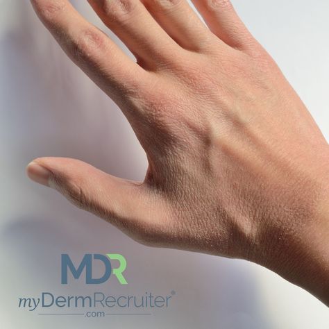 Many people experiencing dry, scaly skin on their hands and deep, painful cracks in their fingers aren’t aware that what they could be dealing with is hand eczema.   Find out more about the difference between dry skin and hand eczema in this article from the AAD today! Rash On Hands, Dry Scaly Skin, Dry Skin Makeup, Prevent Ingrown Hairs, Scaly Skin, Best Moisturizer, Dehydrated Skin, Perfect Skin, Wellness Tips