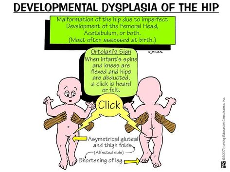 DEVELOPMENTAL DYSPLASIA OF THE HIP Ms Nursing, Developmental Dysplasia Of The Hip, Med Surge, Charting For Nurses, Nursing School Scholarships, Pediatric Nurse Practitioner, Medical Mnemonics, Child Nursing, Nclex Prep