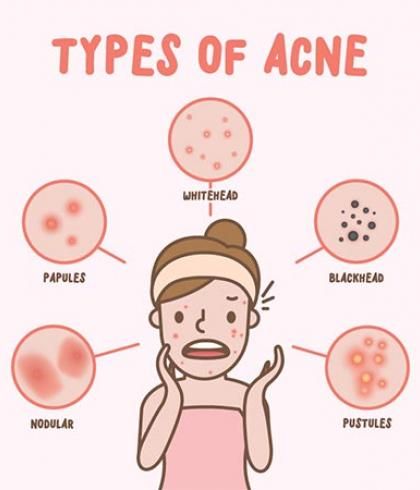 Types Of Pimples, Acne Types, Acne Women, Mild Face Wash, Painful Pimple, Painful Acne, Different Types Of Acne, Pimples On Face, Skin Aesthetics