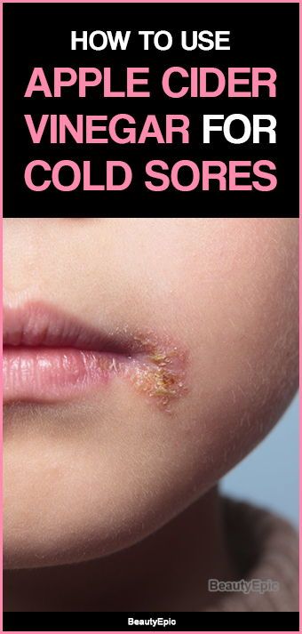 Cold Sore Remedy Fast, Cold Sore Scab, Cold Sore Remedy Overnight, Natural Cold Sore Remedy, Canker Sore Remedy, Cold Sore Relief, Get Rid Of Cold, Cold Sores, Cold Medicine