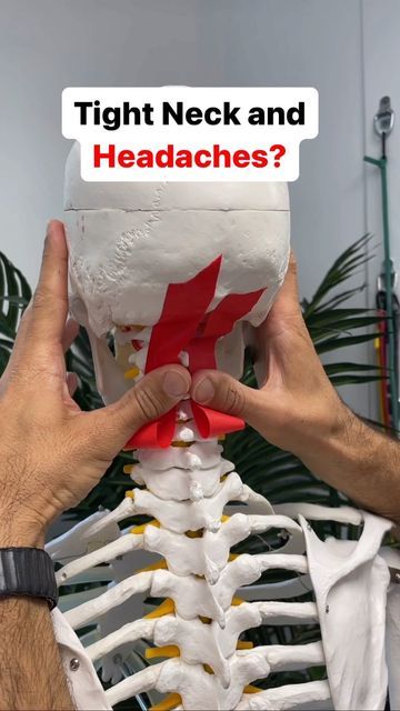 Dr. Joe Damiani - TMJ, Head & Neck Specialist on Instagram: "Do you experience persistent headaches and you also feel tension in the back of the neck and base of the skull? Well, you may be experiencing tightness from the neck which is compressing the nerves at the base of the skull producing suboccipital neuralgia, which is compression of the greater occipital nerve. These types of headaches can be persistent in the back of the head or the side of the head all the way to the eye. This is a great way to release those muscles and free up the space in the base of the skull to reduce headaches. #tensionheadache #headacherelief #migrainelife #cervicogenicheadache #tmjtreatment #tmjdisorder" Tmj Headache, Neck Headache, Reduce Headaches, Spine Problems, Occipital Neuralgia, Headache Types, Neck Exercises, Spine Health, Neck Pain Relief