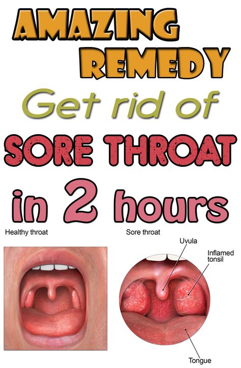 Amazing remedy. Get rid of sore throat in 2 hours - BeautyHealther.net Throat Remedies, Sore Throat Remedies, Strep Throat, Holistic Remedies, Diet Vegetarian, Cold Remedies, Homemade Remedies, Sore Throat, Natural Health Remedies