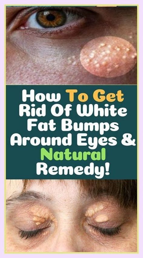 Smashing information and facts White Bumps On Face, Bumps On Face, Under The Skin, White Skin, The Skin, Keratin, Beauty Tips, Beauty Hacks, Skin