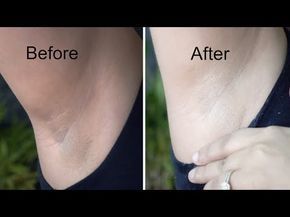 Whiten Dark Underarms in 20 Minutes | Whitening Cream Bleach | Demonstration - YouTube Armpit Whitening, Dark Armpits, Bleaching Cream, Dark Underarms, Dry Skin Patches, Wrinkled Skin, Moisturizing Body Wash, Whitening Cream, Better Skin