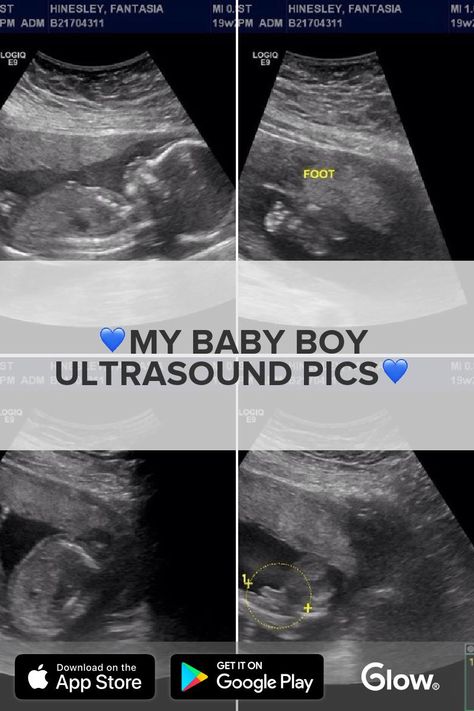 💙My baby boy ultrasound pics💙 - The best ultrasound pics I've seen so far!! My blessing 💚Feet 👣 Thumbs up 👍🏾Definitely a boy 👶🏾 Little hand... - See the rest of this post by downloading Glow Nurture - The Top Rated Pregnancy & Baby Bump Tracker! Baby Boy Ultrasound Pictures, Boy Ultrasound Pictures, 1 Month Pregnant Ultrasound, Boy Ultrasound, 2 Months Pregnant Ultrasound, 3 Weeks Pregnant Ultrasound, 6 Weeks Pregnant Ultrasound, Gender Prediction, Baby Ultrasound