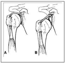 Managing Expectations When Recovering from Labral Repair Shoulder Surgery Recovery, Managing Expectations, Rotator Cuff Surgery, Shoulder Rehab, Rotator Cuff Tear, Shoulder Injury, Shoulder Impingement, Rotator Cuff Injury, Bone Fracture