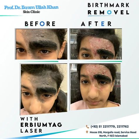 Birthmarks Removal with Erbum Yag laser. Visit www.drikram.com or Call 051 2211779, 2211762 for appointment. Like Our Fb page : https://www.facebook.com/drikramullahkhanofficial Follow us on Instagram https://www.instagram.com/dr.ikramullahkhan/ Subscribe Our You Tube Channel: https://www.youtube.com/channel/UCV_3u0LZQu5axUSnpsUvE7Q #erbiumyaglaser #skinspecialist #topdermatologist #birthmarks #jawlinelift #lipfiller #skindoctor #skincare #lasertreatment Yag Laser, Skin Specialist, Skin Clinic, Lip Fillers, Fb Page, Follow Us On Instagram, You Tube, Say Goodbye, Follow Us