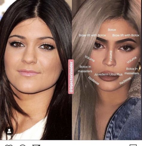 Kylie Jenner Plastic Surgery, Face Plastic Surgery, Botox Brow Lift, Face Fillers, Cheek Fillers, Facial Fillers, Facial Plastic Surgery, Injectables Fillers, Cosmetic Dermatology