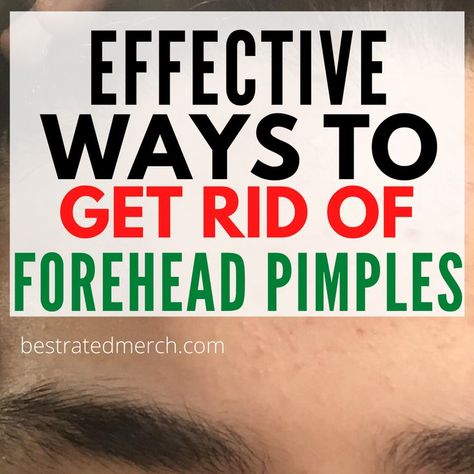 Forehead Pimples, Get Rid Of Forehead Acne, Pimples On Forehead, Forehead Acne, Sunburn Relief, Skincare Hacks, Face Mapping, Types Of Acne, How To Get Rid Of Pimples