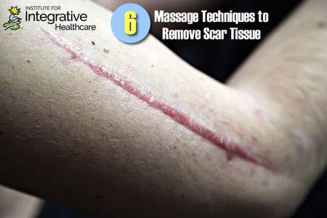 Six Massage Techniques to Remove Scar Tissue Deep Tissue Techniques, Scar Tissue Removal, Scar Tissue Massage, Surgery Prep, Scar Massage, Surgery Aesthetic, Knee Rehab, Fascia Blasting, Mastectomy Scars