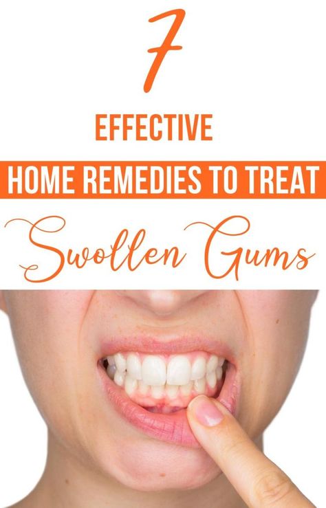 Dental Health Healing Cavities, Toddler Tooth Decay, Teeth Remedies, Tooth Decay Remedies, Heal Cavities, Swollen Gum, Health Routine, How To Prevent Cavities, Oral Care Routine