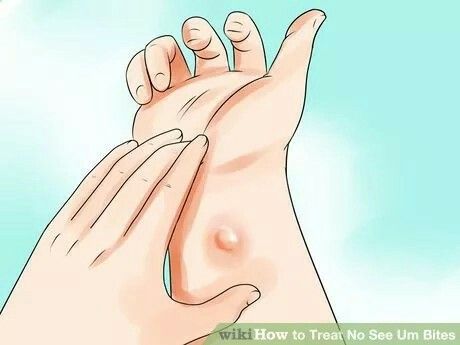 How to treat no see um bites Bug Bite Relief, Bite Relief, Health Topics, Bug Bites, Flying Insects, No See, Insect Bites, Insect Repellent, In Case Of Emergency