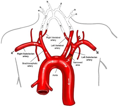 Subclavian Artery, Vertebral Artery, Rare Disorders, Blood Pressure Medications, Google Scholar, Coronary Arteries, Chest Pain, School Of Medicine, Blood Vessels