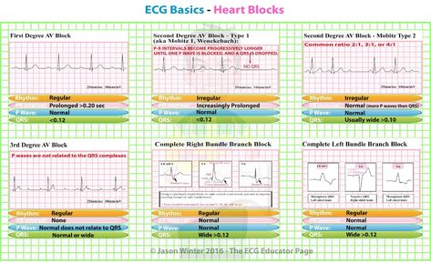 ECG Educator Blog : Heart Blocks Junctional Rhythm, Ccrn Review, Ekg Technician, Rhythm Worksheets, Bundle Branch Block, Cardiology Nursing, Ekg Interpretation, Paramedic School, Cardiac Rhythms