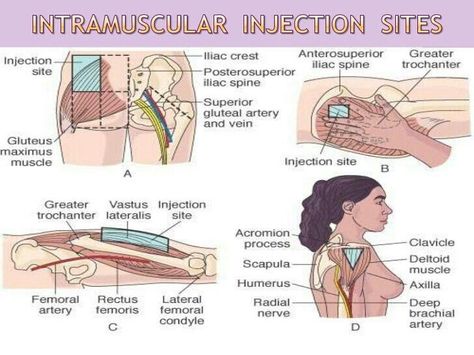 Intramuscular injection Gluteal Injection Site, Intramuscular Injection Sites, Im Injection Sites, Intramuscular Injections, Injection Sites, Im Injection, Nursing Procedures, Medical Assisting, Nursing Board