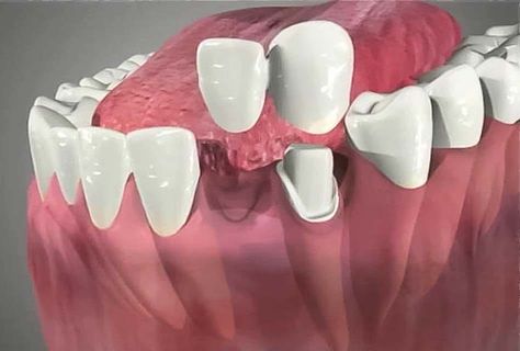 Wisdom Teeth Extraction, Teeth Extraction, Dental Bridge Cost, Wisdom Teeth Pain, Cantilever Bridge, Teeth Whitening Methods, Teeth Whitening Procedure, Wisdom Tooth Extraction, Dental Restoration