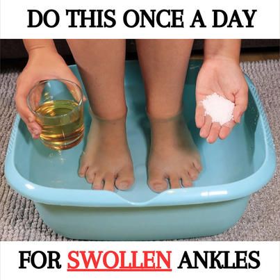 Pure Recipes - Warning signs of those swollen ankles that... Swollen Feet Remedies How To Get Rid, Swollen Legs And Ankles, Swelling In Feet And Ankles Remedies, Reduce Ankle Swelling, Exercises To Reduce Ankle Swelling, Swollen Ankles, Lymph System, Warning Signs, Natural Medicine