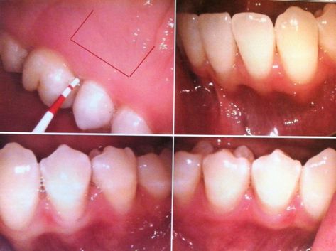 Soft Foods To Eat, Gum Graft, Dental Bridge Cost, Gum Removal, Gum Surgery, Gum Recession, What Can I Eat, Skin Grafting, Teeth Whitening Diy