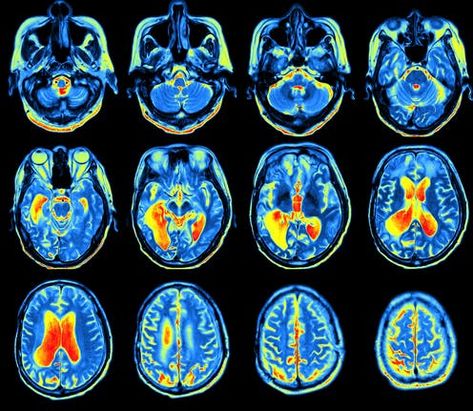 Mri Brain, Brain Mapping, Brain Images, Pet Scan, Precision Medicine, Brain Scan, The Human Brain, Magnetic Resonance Imaging, Brain Activities