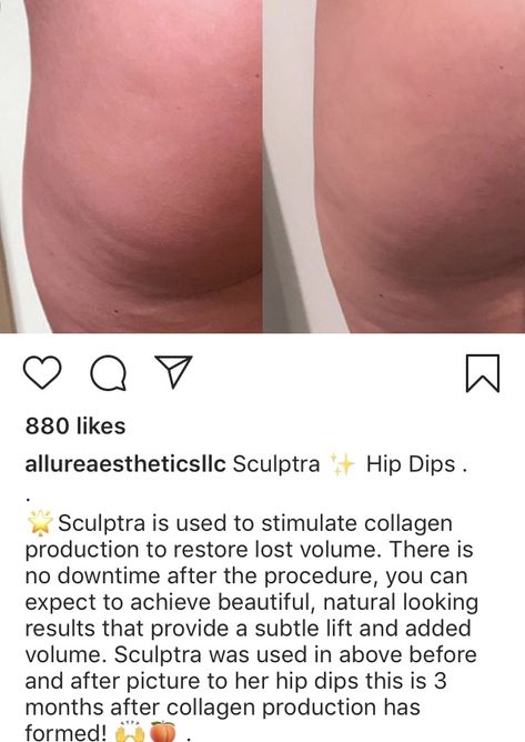 Sculptra Before And After, Hips Dips Before And After, Hip Dips Before And After, Celebs Without Makeup, Hips Dips, Random Inspiration, Diy Beauty Recipes, Work Outs, Before And After Pictures