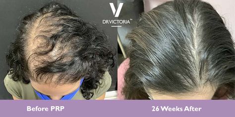 Platelet Rich Plasma (PRP) Therapy for Skin & Hair in Edinburgh Prp Therapy, Prp Hair, Female Pattern Baldness, Platelet Rich Plasma, Facial Aesthetics, Aesthetic Medicine, Facial Rejuvenation, Dental Surgery, Hair Follicles