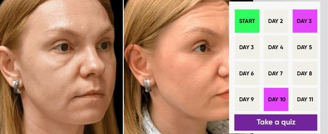 Festoons Under Eyes Before and After Mewing Mewing Before And After, Facial Sculpting, Muscles Of The Face, Lymph System, Injectables Fillers, Fluid Retention, Facial Exercises, Derma Roller, Under Eye Bags