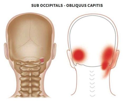 Headache Back Of Head, Tension Headache Remedies, Acupressure Headache, Tension Headache Relief, Trigger Point Release, Shiatsu Massage Acupressure, Headache Relief Instant, Occipital Neuralgia, Migraine Remedies