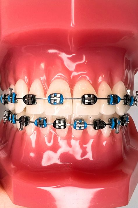 Dare to be different with teal braces. This teal and black combination will make you want to smile! Explore playful braces color combinations that include teal. More on the website! Black Braces Color, Braces Combos, Teal Braces, Brace Ideas, Dental Braces Colors, Braces Colors Combinations, White Braces, Braces Ideas, Red Braces