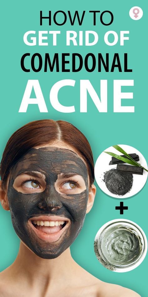 Comedonal Acne, Back Acne Remedies, Acne Overnight, Skincare Acne, Acne Skincare Routine, Natural Acne Remedies, Home Remedies For Acne, Types Of Acne, Face Acne