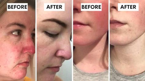 Best skincare for red complexion: Beauty therapist’s ‘miracle’ new ‘anti-redness’ product boosts hydration by up to 25 per cent | 7NEWS Remove Redness From Face, Get Rid Of Redness On Face, Covering Redness On Face, How To Reduce Redness On Face, Acne Redness Reducing Skin Care, Reduce Redness In Face Acne, Reduce Facial Redness, Redness On Face, Anti Redness