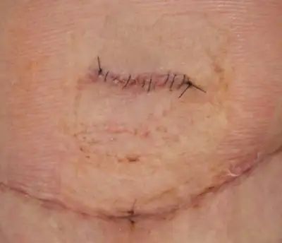 My Bilateral Mastectomy and TRAM Flap Reconstruction: 11-Month Update - Patient's Lounge Bilateral Mastectomy, Stomach Muscles, Abdominal Surgery, Feeling Numb, Button Hole, Post Surgery, After Surgery, Hot Flashes, Belly Button