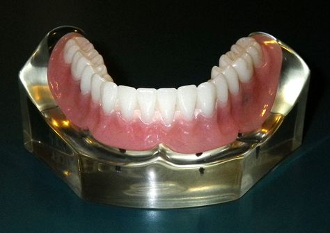 Permanent Dentures, Dental Dentures, Implant Dentist, Denture Implants, Denture Adhesive, General Dentistry, Dental Procedures, Gold Caps, Dentures