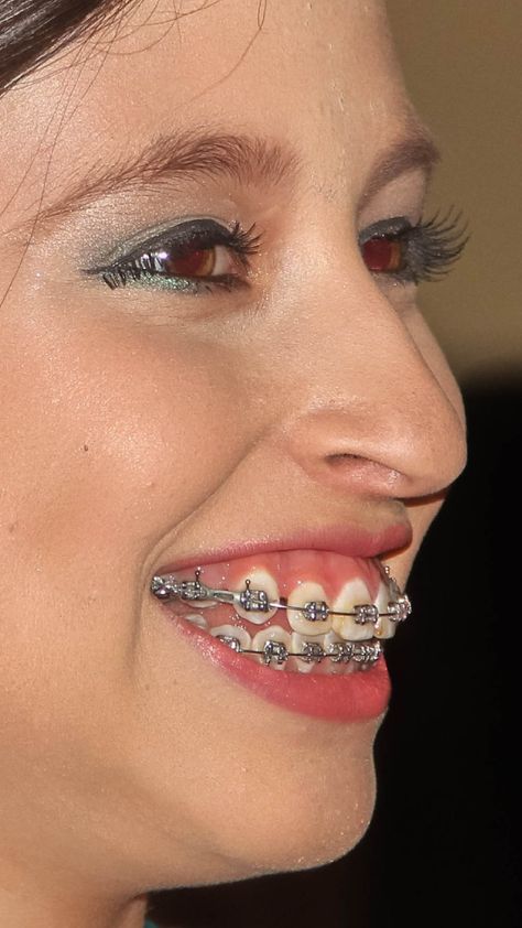 Braces Girl, Braces Colors Combinations, Braces For Teeth, Jewelry Teeth, Braces Colors Ideas, Teeth Gems, Braces Cost, Braces Girls, Orthodontic Appliances