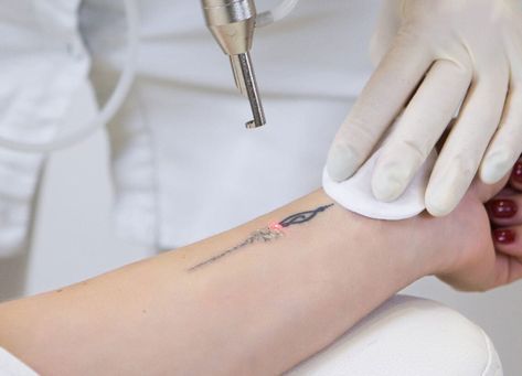 Picosure Tattoo Removal, Tattoo Removal Cost, Trending Tattoo, Laser Removal, Laser Clinics, About Tattoo, Laser Tattoo, Laser Tattoo Removal, Cosmetic Treatments