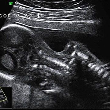 Find out what new things you might see on an ultrasound when you're 19 weeks pregnant. Plus, learn what happens to his or her skin as your baby moves around. Fetal Development Week By Week, 19 Weeks Pregnant, Baby Weeks, Baby Slide, Amniotic Fluid, Fetal Development, Unborn Baby, Second Trimester, Adipose Tissue