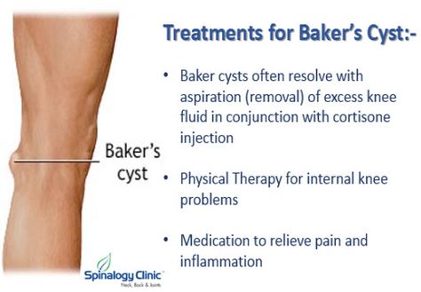 Treatments for Baker Cysts… #BakerCyst #jointpain #Swelling Baker Cysts, Bursitis Knee, Knee Meniscus, Body Facts, My Knee Hurts, Swollen Knee, Knee Problem, Knee Exercises, Knee Pain Relief