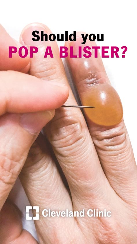 Should you pop or break a blister? Blister In Mouth, How To Treat Blisters, Blister Remedies, Water Blister, Sunburn Blisters, Blister On Lip, How To Heal Blisters, Blister Care, Blood Blister