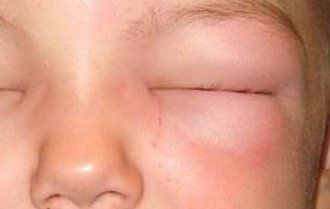 Swollen Eyelids Remedy, Swollen Eye Remedies, Itchy Eyelids, Swollen Eyelid, Puffy Eyes Remedy, Allergy Eyes, Swollen Eyes, Allergy Remedies, Upper Eyelid