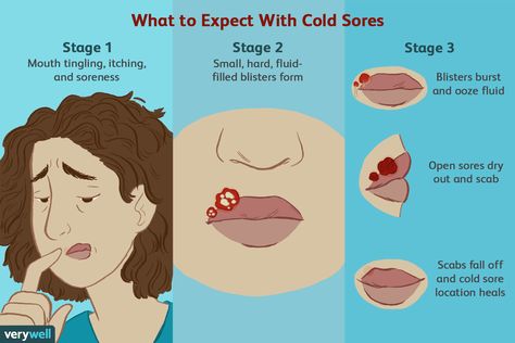 cold sore stages Lip Blister Remedy, Coldsore Remedies Overnight, How To Get Rid Of Cold Sores Overnight, How To Get Rid Of Cold Sores, Cold Sore Remedy Quick Overnight, Fever Blister Remedy Fast, Fever Blister Causes, Cold Sore Remedy Fast, Cold Sore Scab