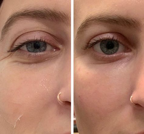 Before and Immediately After Getting the Fillers Eye Filler, Under Eye Fillers, Circle Face, Facial Plastic, Under My Skin, Popsugar Beauty, Under Eye Bags, Cosmetic Procedures, Dermal Fillers