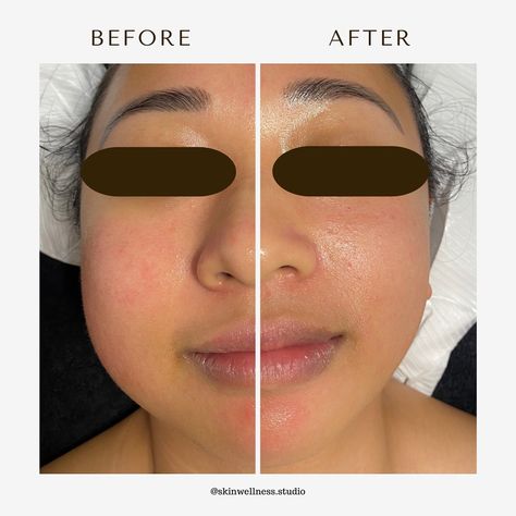 The power of facial lymphatic drainage + buccal massage 🌸 Our faces hold a lot of fluid throughout the day as the lymphatic system works to filter waste and toxins from tissues. When this delicate system becomes sluggish or overloaded, it can lead to puffiness and swelling around the eyes, jowls and cheeks that makes our skin appear tired and drawn. #transformationthursday #buccalmassage #mld #guasha #facialcupping #beforeandafter #puffyeyes #lymphaticdrainage #montreal #holisticesthetician... Buccal Massage, Facial Cupping, Puffy Eyes, Gua Sha, Esthetician, Montreal, Massage, Facial, Filter