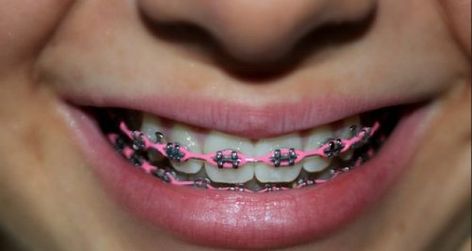 Light pink power chain #braces #pink #braces Pink Braces Power Chain, Pink Power Chain Braces, Neon Pink Braces, Power Chain Braces, Dental Braces Colors, Braces Colors Combinations, Braces Ideas, Pink Braces, Power Chain