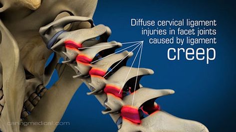 Prolotherapy for Neck Pain and Cervical Instability – Caring Medical Florida Carpal Tunnel Relief Exercises, Cervical Instability, Posture Stretches, Carpal Tunnel Relief, Cervical Disc, Text Neck, Forward Head Posture, Neck Problems, Ligament Injury